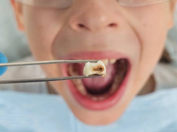 Best Emergency Broken Tooth Repair in Deer Park, NY